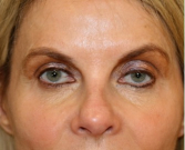 Feel Beautiful - Blepharoplasty Upper Eyelids 103 - Before Photo